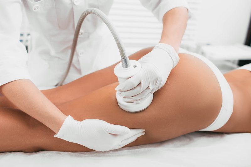 woman having cavitation, procedure removing cellulite on her buttocks , lifting buttocks